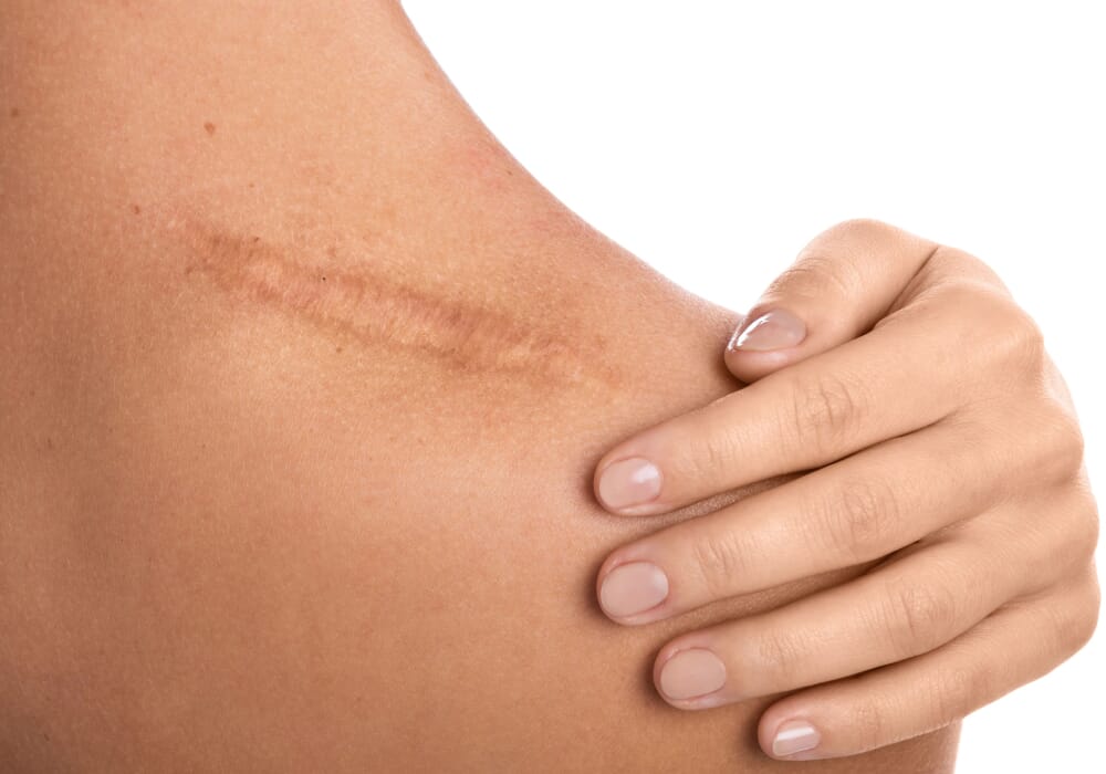 cicatrice spalla ipertrofica