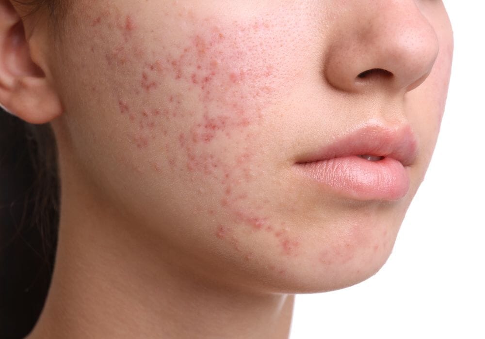 acne.jpg
