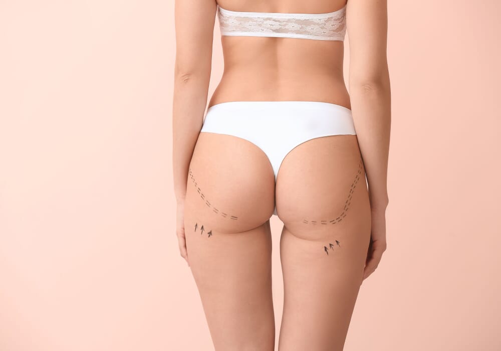 aumento-gluteo.jpg