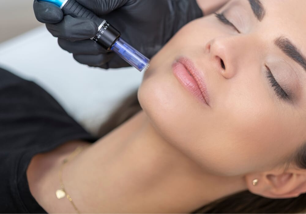 needling.jpg